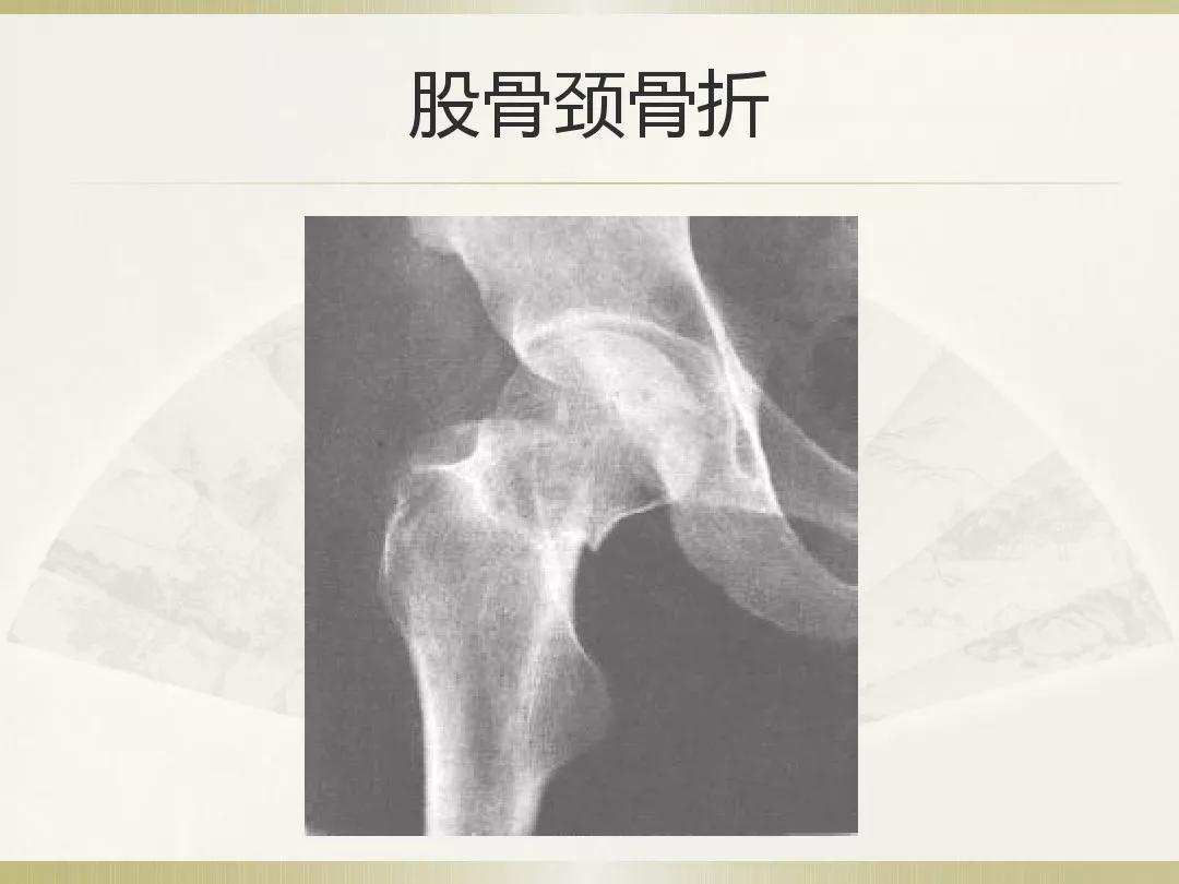 骨科x光片读片技巧,放射科骨科读片教程