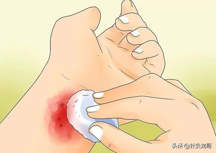 针灸出现淤青怎么处理,针灸出现淤青是不是血瘀了