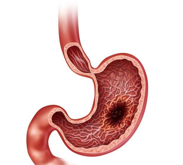 经常胃溃疡怎么养胃,胃溃疡胃痛胃胀快速缓解