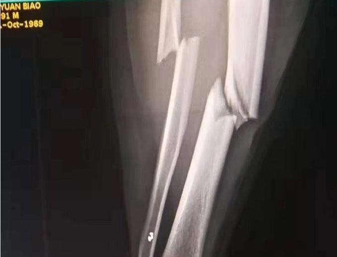 中国足坛十大断腿惨剧,中国足坛断腿事件