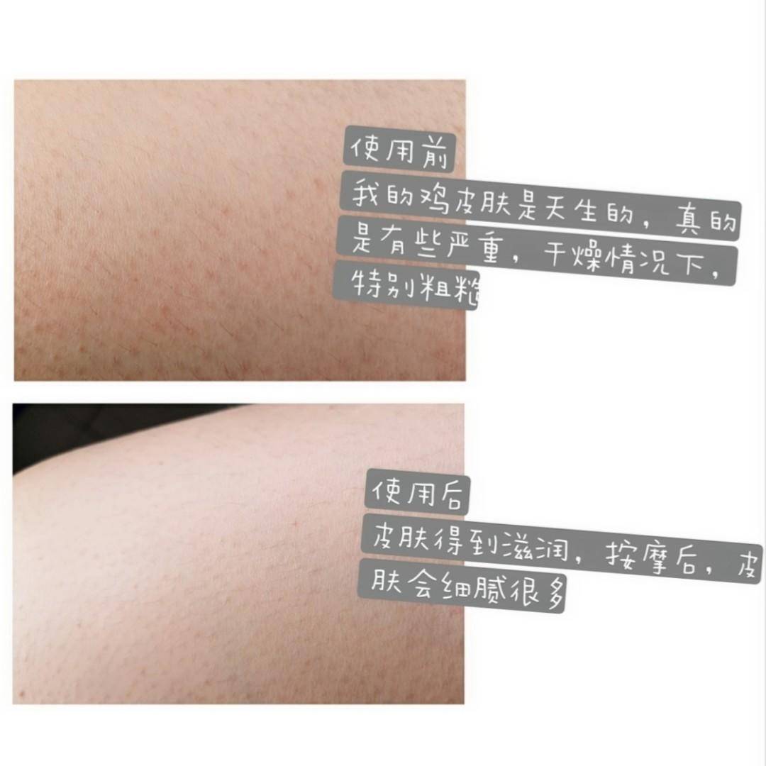 关节去黑小妙招,怎么预防关节变黑