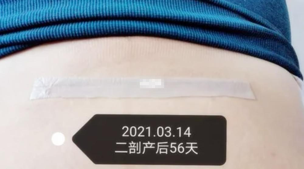 为什么剖腹产伤口会疤痕增生,剖腹产伤口疤痕变化