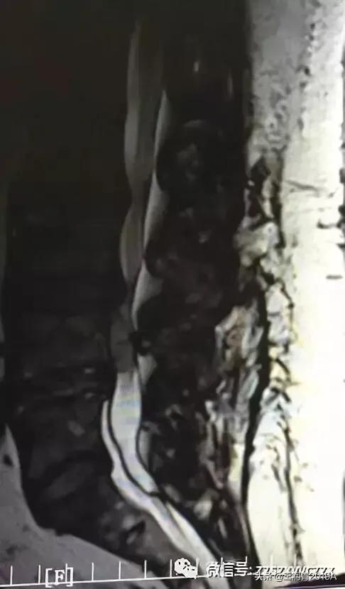 弯腰捡东西，腰痛腿麻大小便*禁失**，竞是腰椎间盘髓核脱出惹的祸