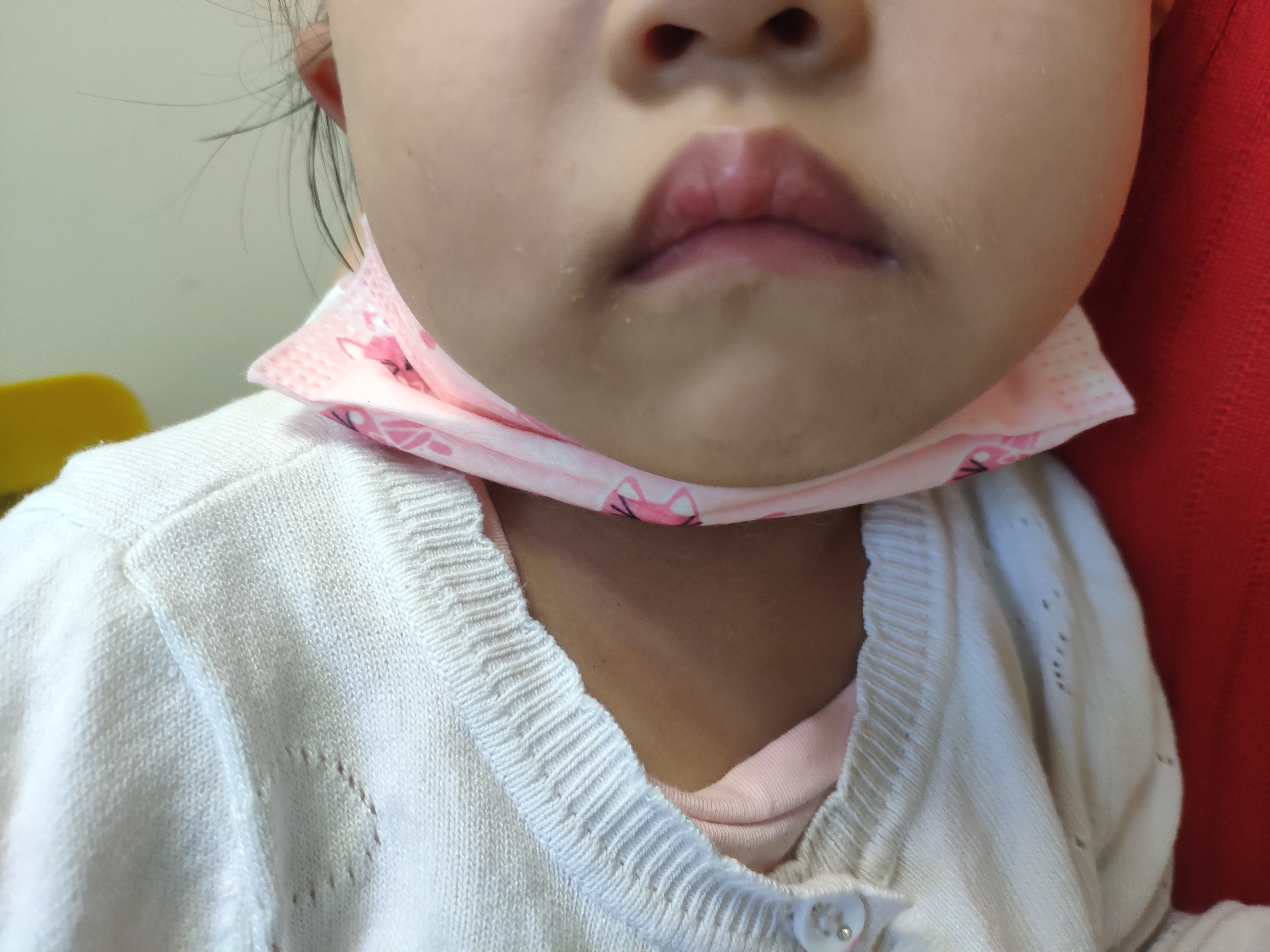 4岁儿子脾气暴躁，安静不了，是腺样体肥大还是多动症，要手术吗