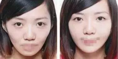 明星注射玻尿酸案例,注射玻尿酸变美