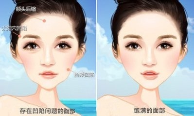 脸部皮肤松弛凹陷适合玻尿酸填充,脸部凹陷还下垂松弛做全脸填充吗