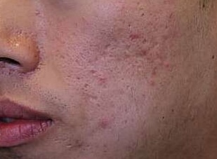 痘痘没了又长怎么解决,痘痘没了毛孔很大怎么办