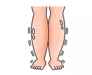 糖尿病下肢水肿,倪海厦下肢水肿