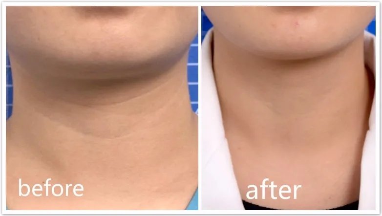 18岁脖子上有颈纹怎么按摩,18岁怎么去颈纹