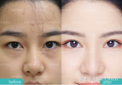 内双的人割双眼皮会更自然吗,怎么把内双变双眼皮的自然方法