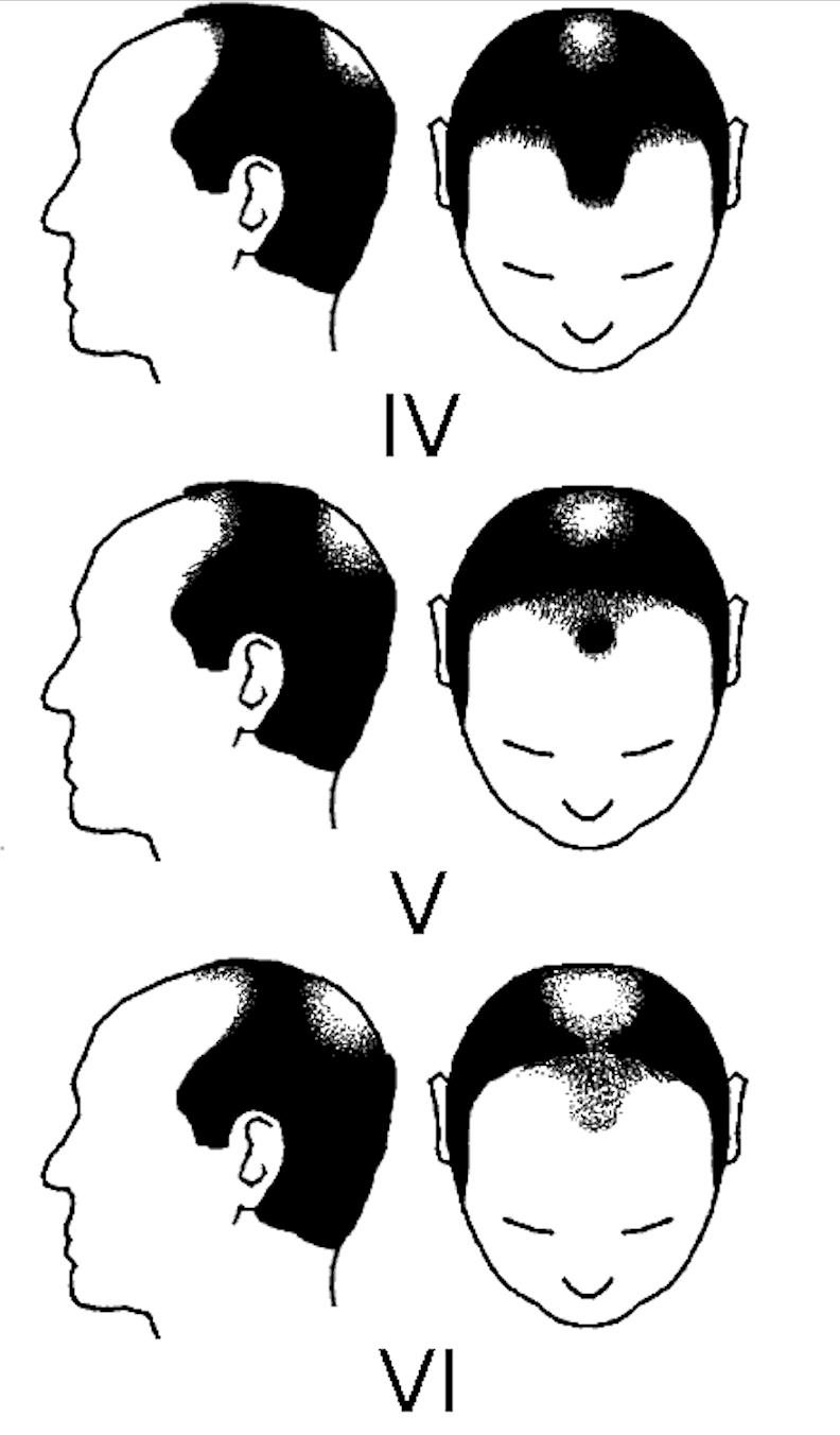 中年男性脱发原因及治疗方法,中年男性遗传性脱发能治好吗