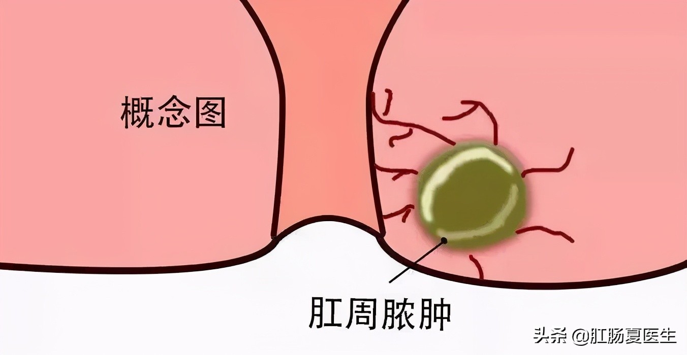肛周脓肿到底是个什么东西,最轻微的肛周脓肿是什么表现