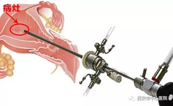 【献礼母亲节】母亲节，别忘了孕育宝宝的宫殿——聊聊宫腔镜的应用