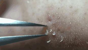 解决顽固黑头轻松去除草莓鼻,祛闭口粉刺草莓鼻