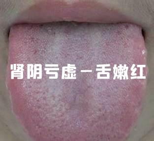 肾阴虚肾阳虚和肾精亏虚怎么分别,肾阴虚肾阳虚肾精亏有什么区别