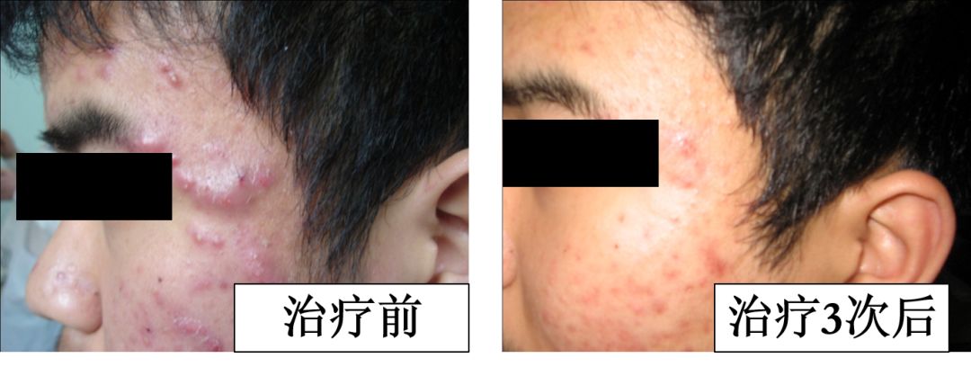 中医火针疗法教学视频,火针操作手法