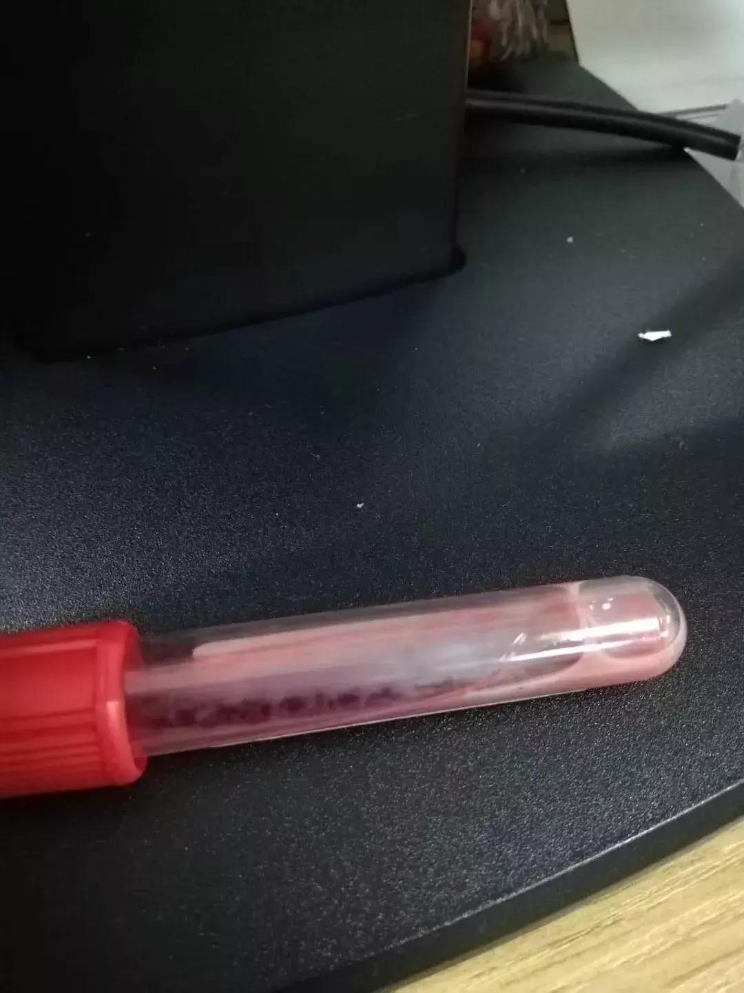 怀胎32周孕妇突发腹疼,抽血检查发现半管都是油脂?!