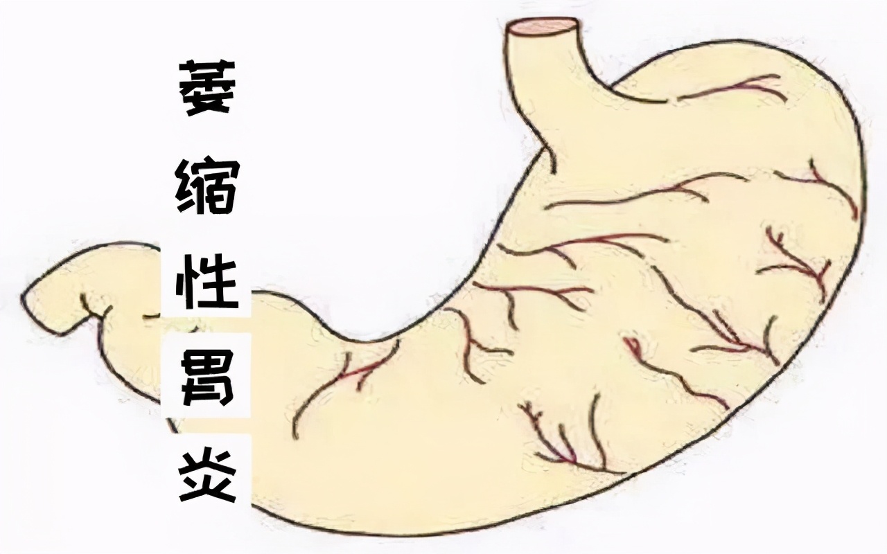 萎缩性胃炎就是胃变小了吗,胃口变小和萎缩性胃炎是一样吗