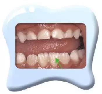 孩子换牙后牙齿越来越难看,小孩换牙为什么牙齿凹凸不平图片