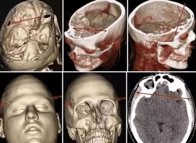 头部中弹为什么没反应,头部被子弹击中能不能抢救