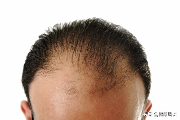 男人年轻就秃顶的原因是什么,为什么只有男性会秃顶