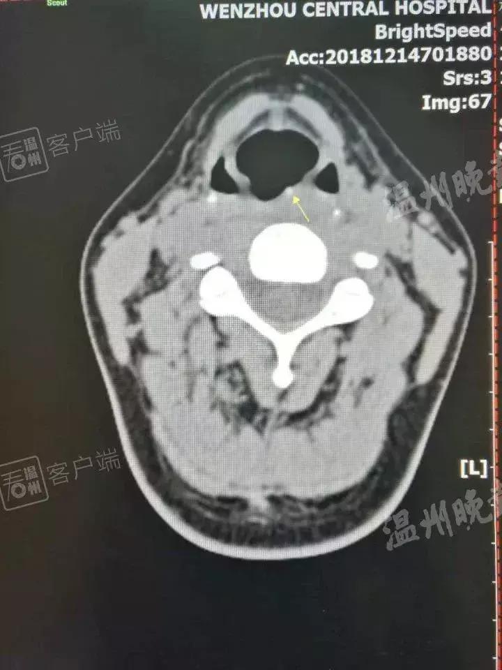 吃了烧烤喉咙剧痛,吃烧烤喉咙剧痛