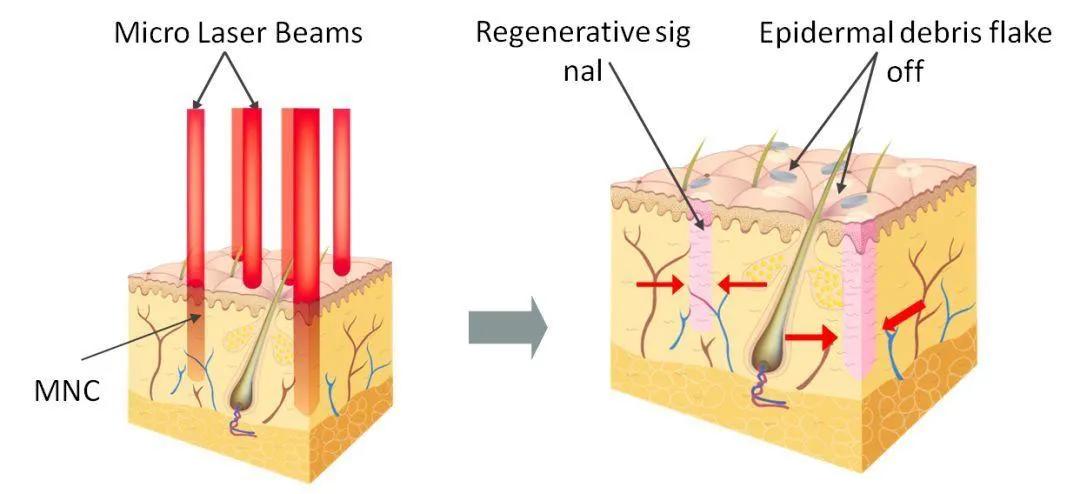 激光手术的创伤怎么消毒,做完脉冲激光破皮了怎么办