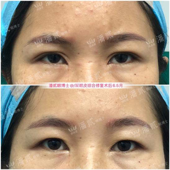 双眼皮太深显老怎么修复,双眼皮失败后修窄
