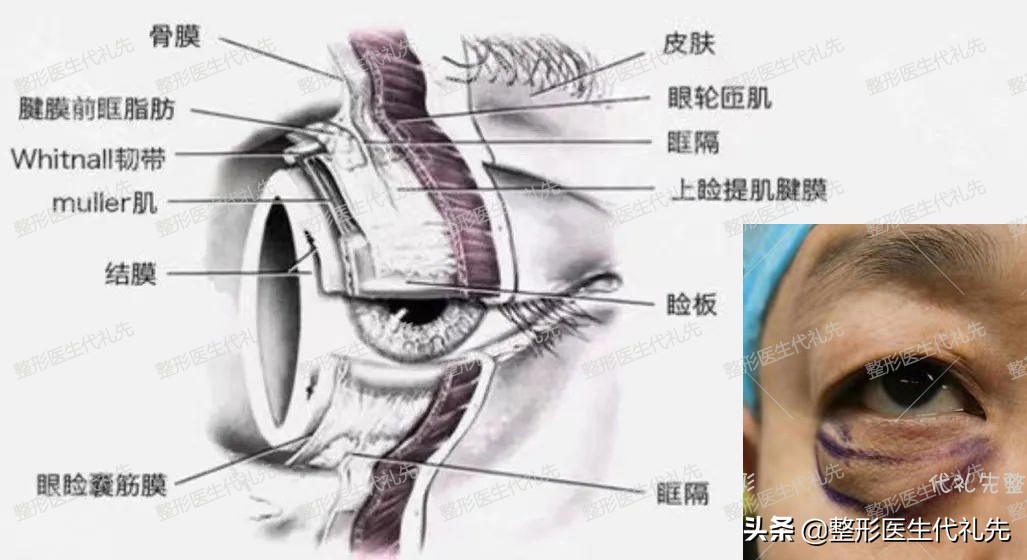 眼袋遗传的原因,眼袋大最简单手术去眼袋的方法