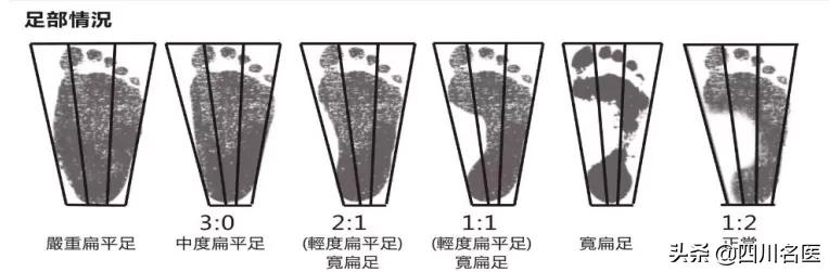 走路扁平足是什么原因,走路脚掌痛是大病前兆