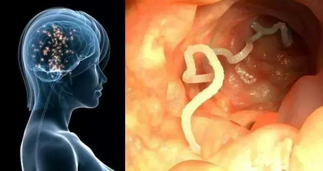 28岁小伙癫痫16年，脑子被虫吃了！竟是爸爸给他吃这个珍稀“大补”！