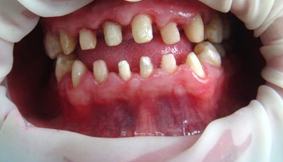 吴宣仪做牙齿前后对比,吴宣仪做整牙