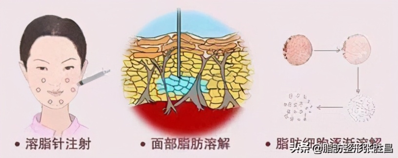 想瘦但又不想减肥,注射溶脂针还能吸脂吗