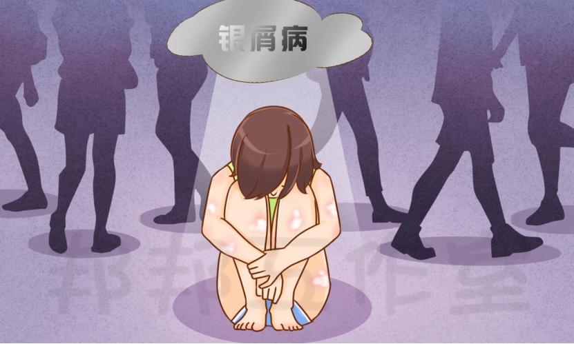 斑块状银屑病治疗方法,中度斑块银屑病怎么治疗最好