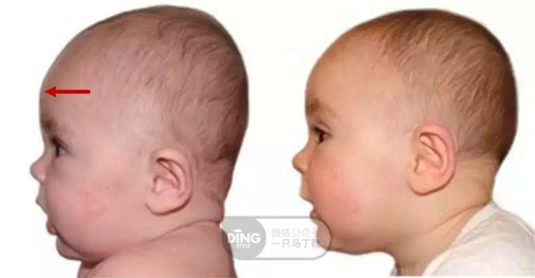 扁头有什么办法改善头型吗,扁头怎么让头变得饱满些