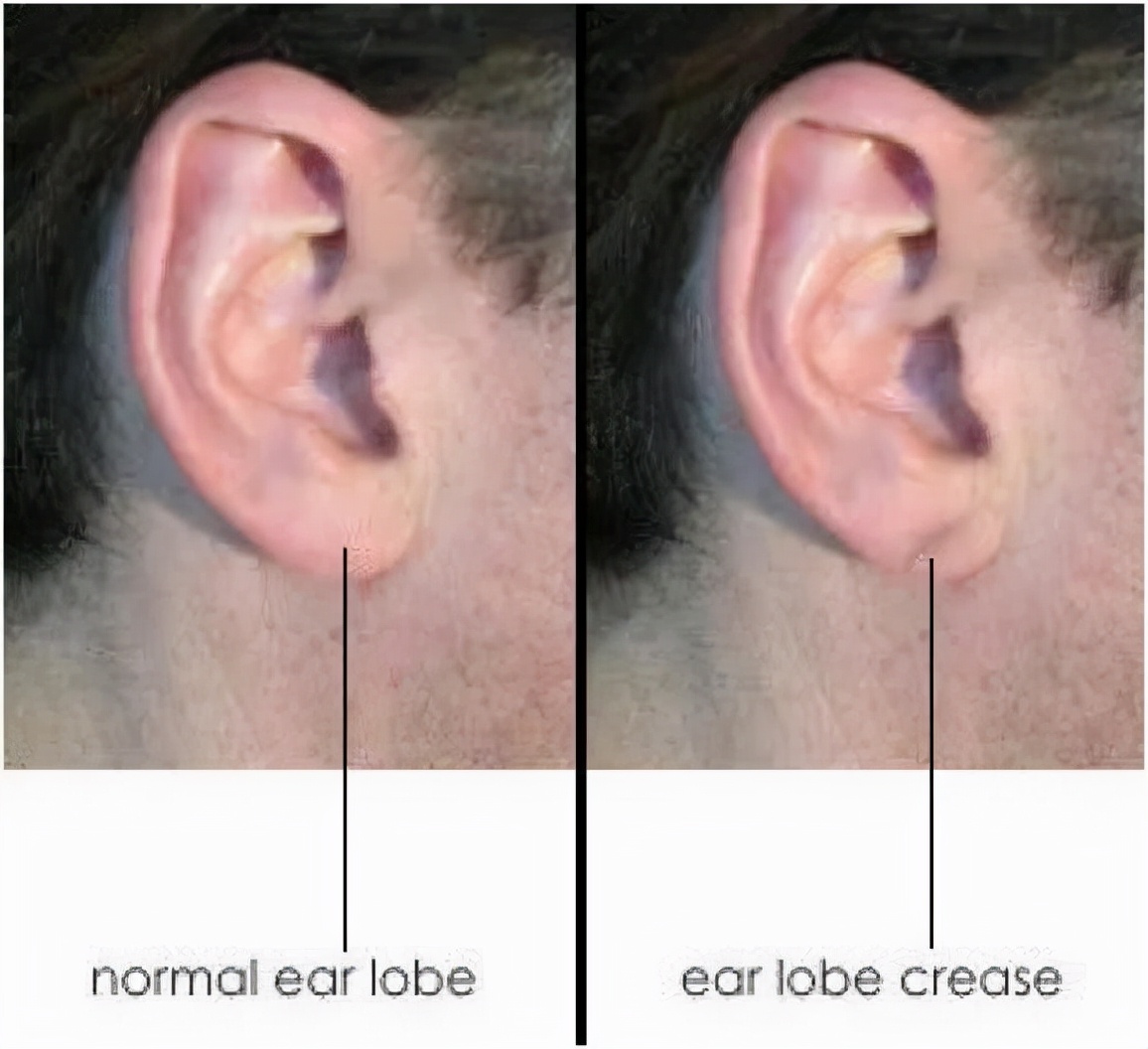 耳垂褶皱是冠心病的征兆吗,耳垂褶皱是冠心病前兆