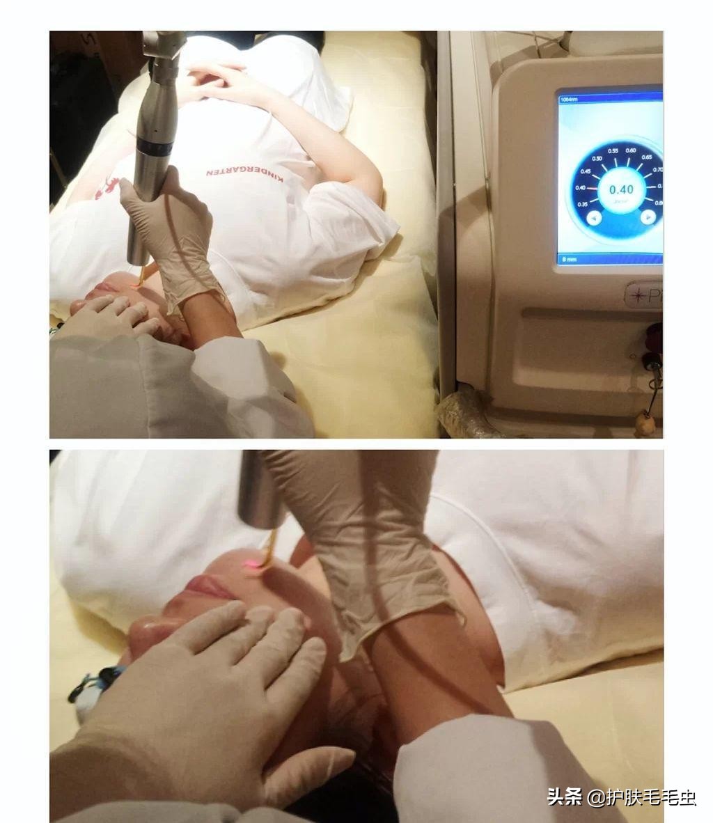 脸上长斑什么原因怎么消除,脸上长斑严重如何调理最简单有效