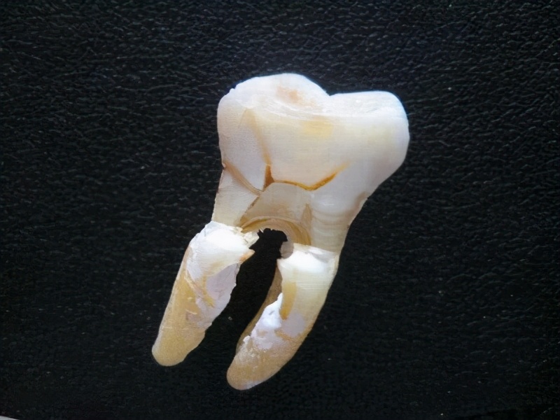 牙痛怎么办早期三大症状,请说出牙痛九个诱因