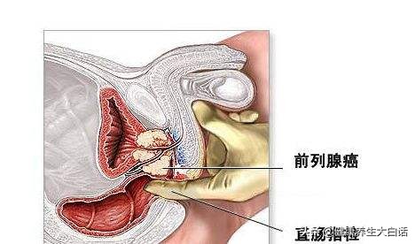 肛门坠胀感是什么原因该怎么治疗,肛门坠胀怎么治疗快好