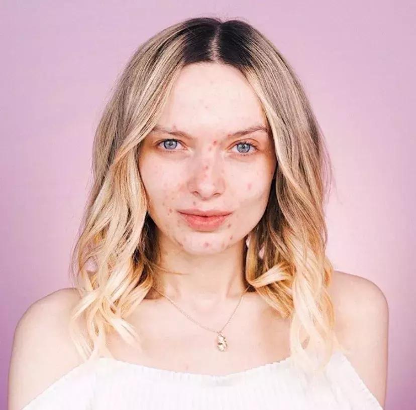 黑眼圈淡斑,色素型黑眼圈太重怎么调理