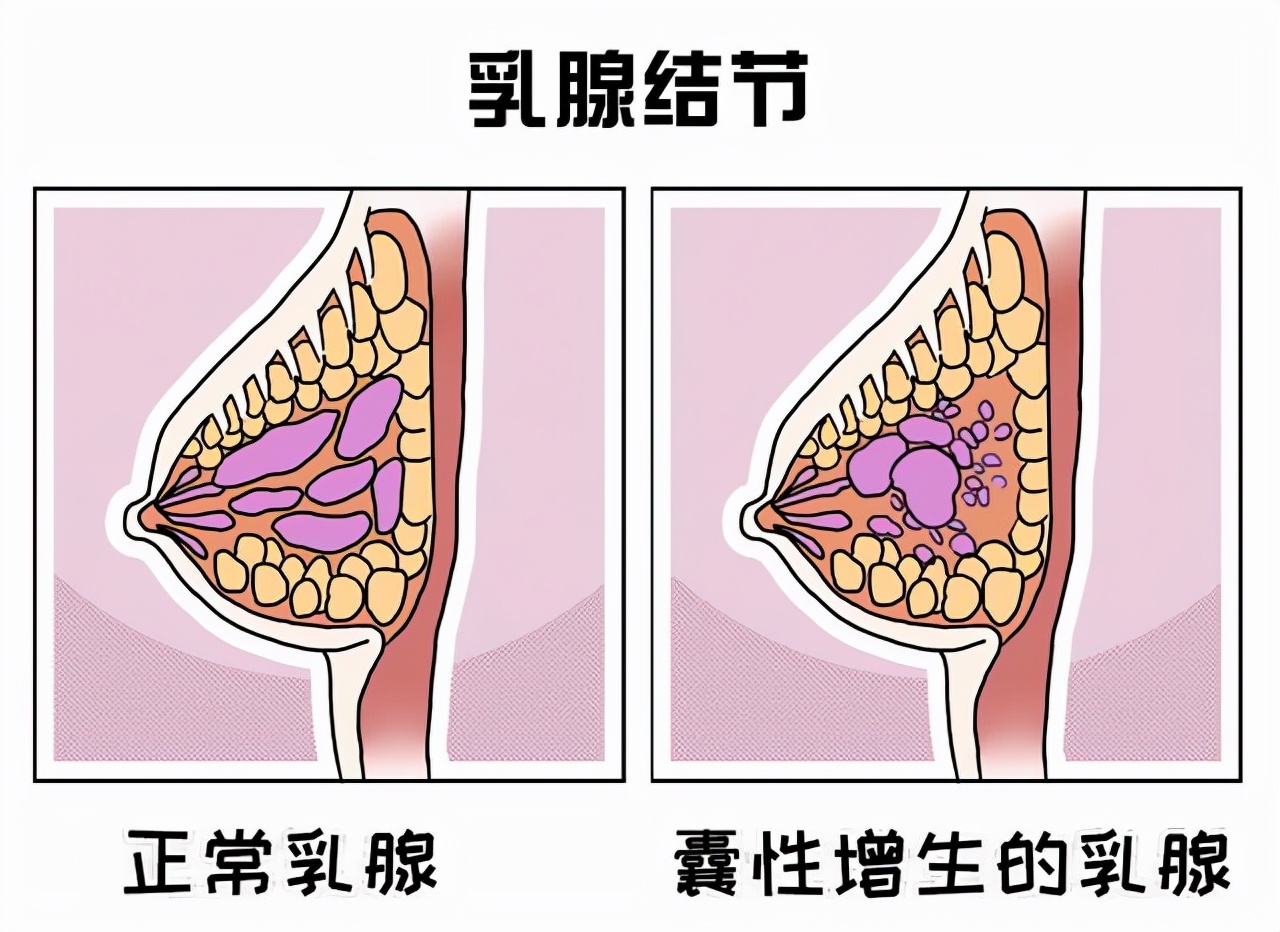 乳房结节怎么手术切除,乳房结节切除是立即病理确诊吗