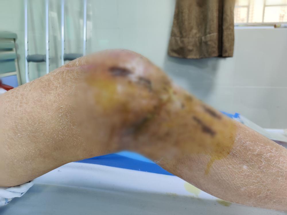 男士膝盖破了怎么办,膝关节破了个洞