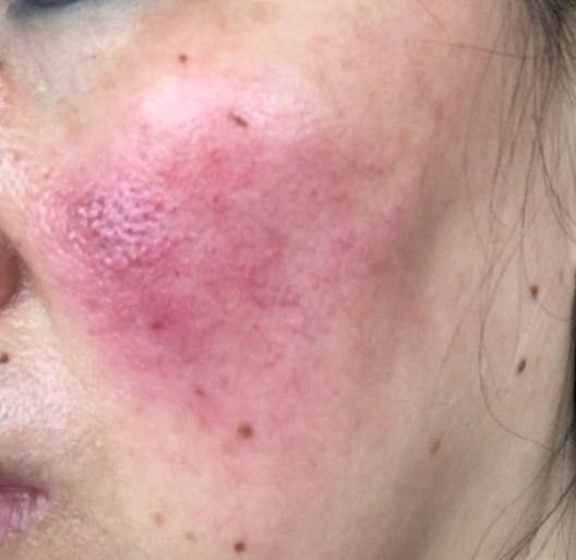 敏感肌适合的洗面奶乳液,适合红血丝皮肤的乳液