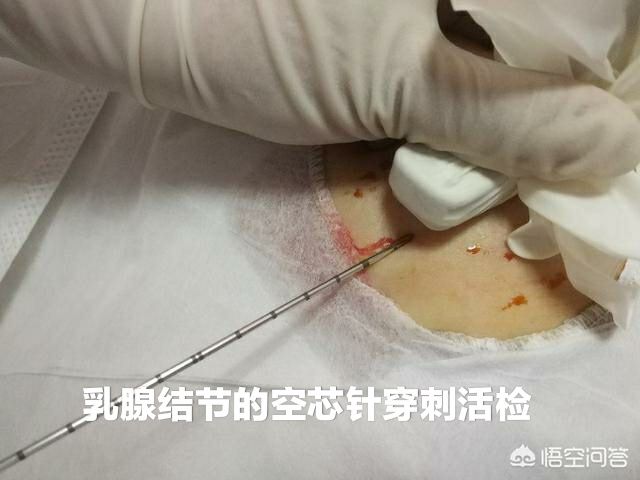 乳腺结节三级有一辈子不癌变的吗,乳腺结节属于病吗