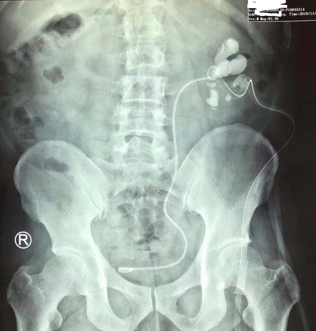 疯狂的石头除藻,肾结石鹿角形状的结石什么样