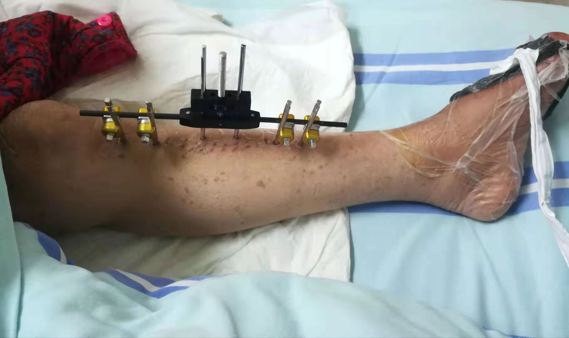 中西医结合治疗糖尿病,糖尿病足中西医结合指南