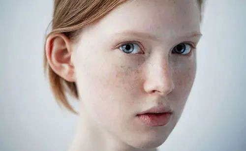 脸上斑点很多祛斑最有效的办法,皮肤不好有斑怎么祛斑