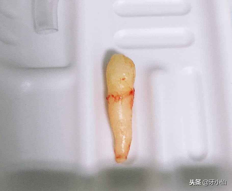 拔牙到底疼不疼几分钟能搞定,拔牙后很疼是伤到牙神经了吗