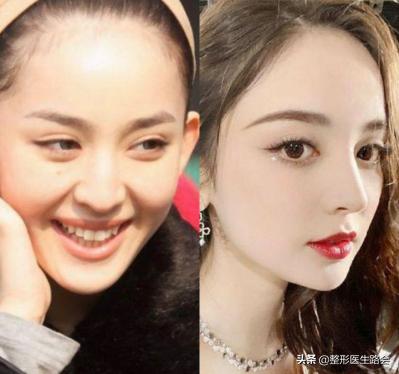 鼻翼缩小和鼻翼缩小之后的对比,超有效的缩小鼻翼的方法