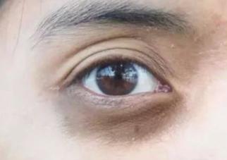 在人人爱美的时代，黑眼圈很重怎么办？缓解黑眼圈的有效办法推荐